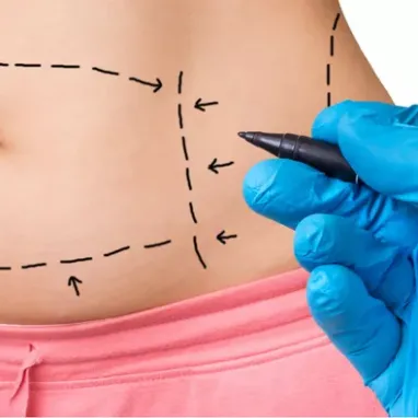 Tummy Tuck