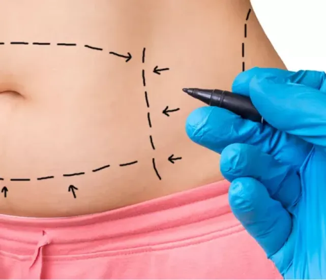 Tummy Tuck